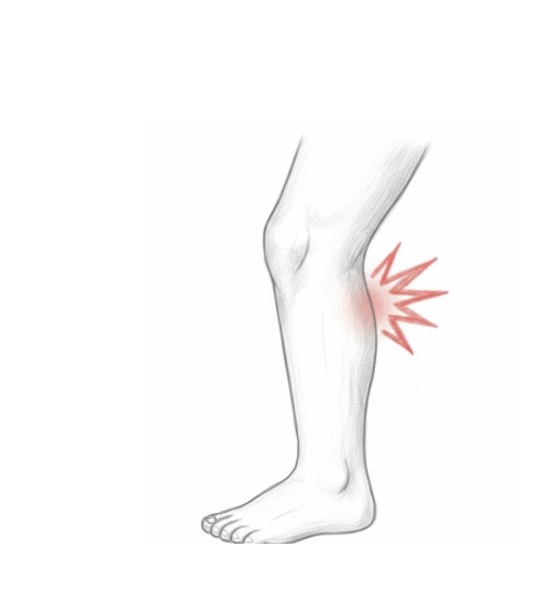 Symptom: Audible Pop for ACL Injury