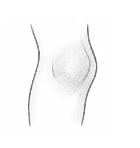 Symptom: Sudden Swelling for ACL Injury